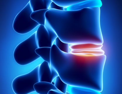 Причина и лечение стертого межпозвоночного диска