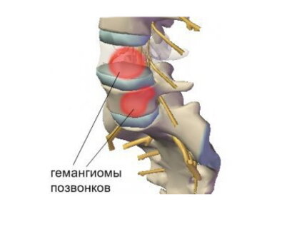 Гемангиома позвоночника: причины возникновения, симптоматика и лечение