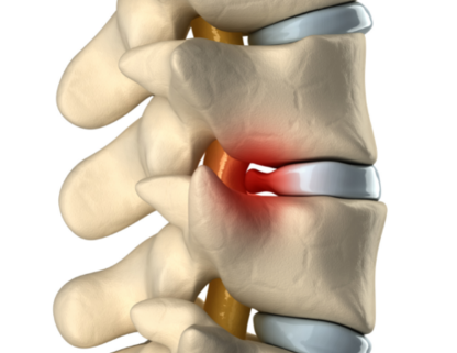 Грыжа межпозвоночного диска