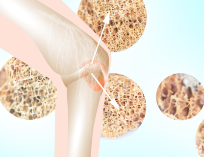 Остеопороз – потеря костной массы