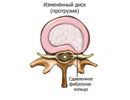 Протрузия межпозвонкового диска